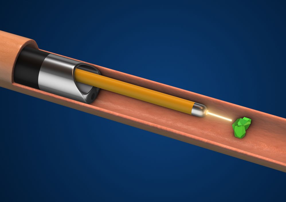 An illustration of a laser lithotripsy procedure within a kidney