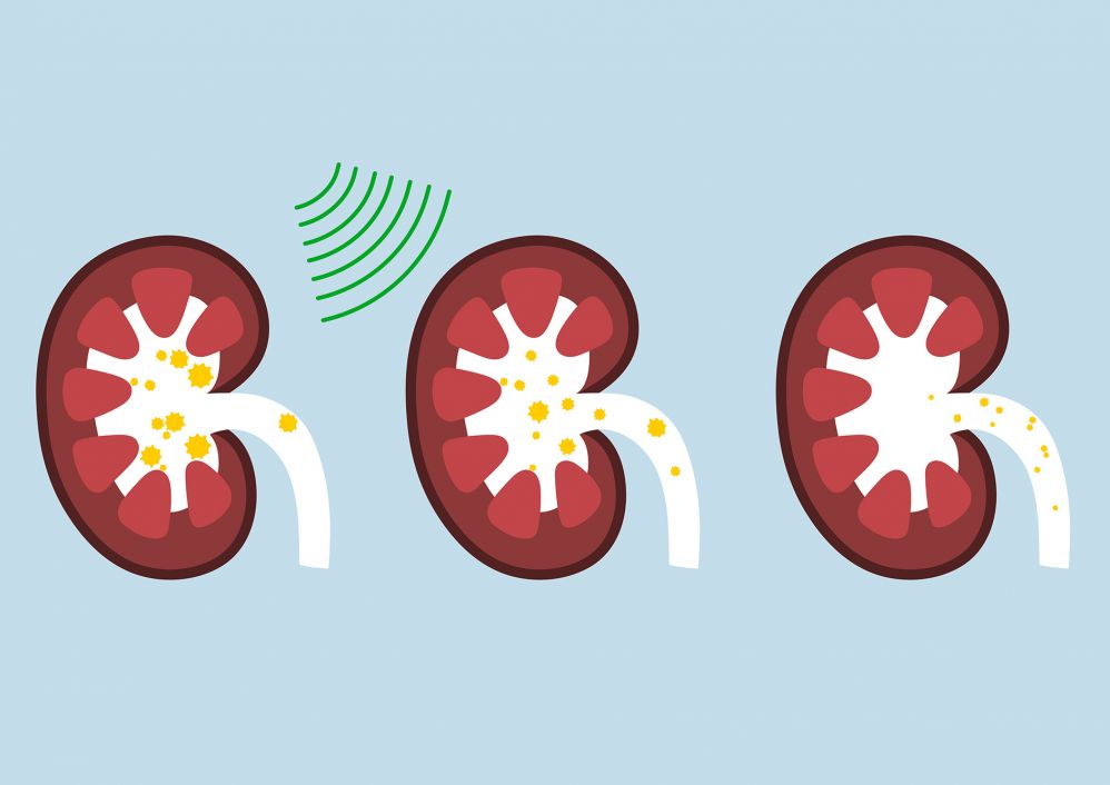 An illustration demonstrating a Extracorporeal Shock Wave Lithotripsy procedure.