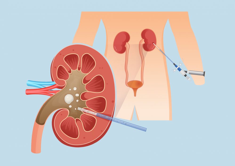 An illustration of a Percutaneous Nephrolithotomy procedure