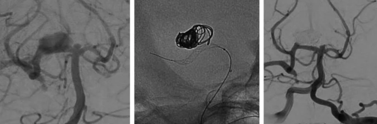 Collage of aneurysm photos